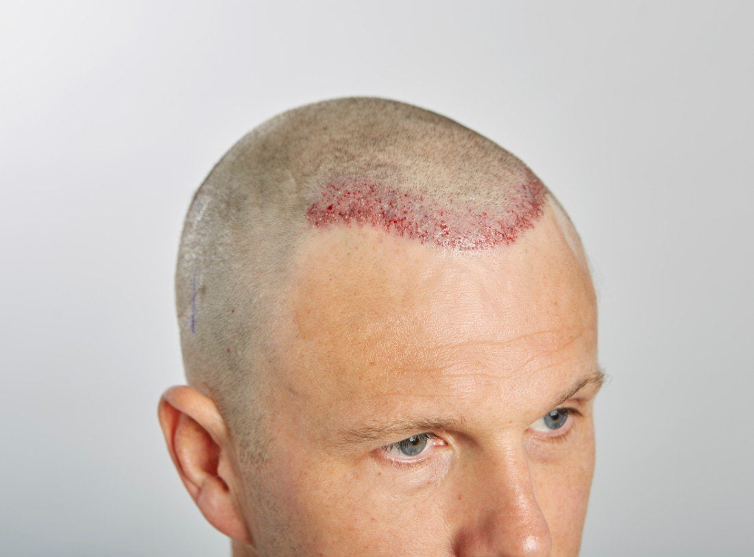 Post hair transplant operation FUE treatment